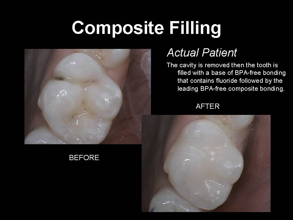 composite filling before and after
