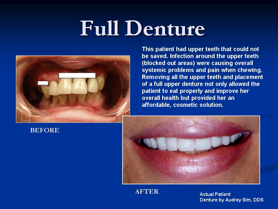 full denture before and after