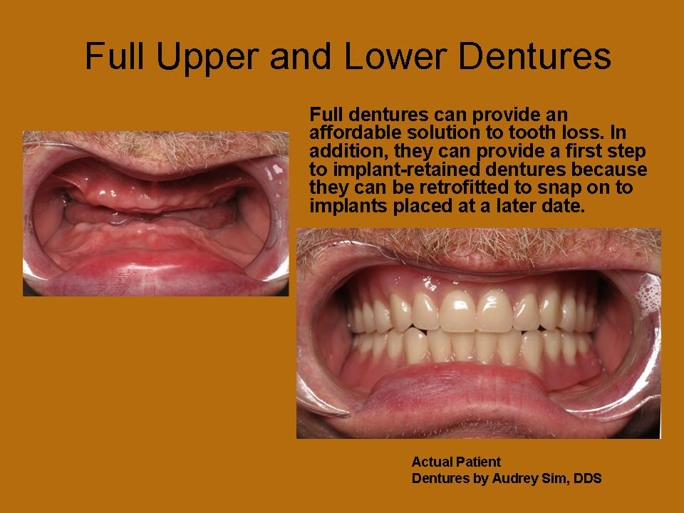 full upper and lower dentures