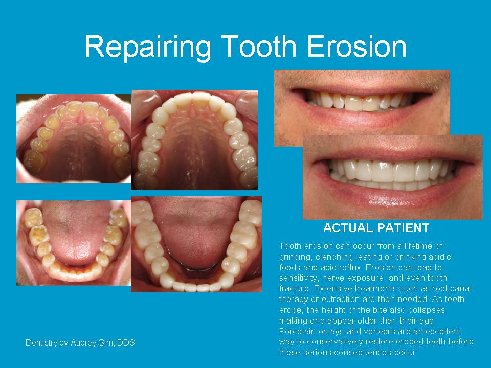 Repairing tooth erosion