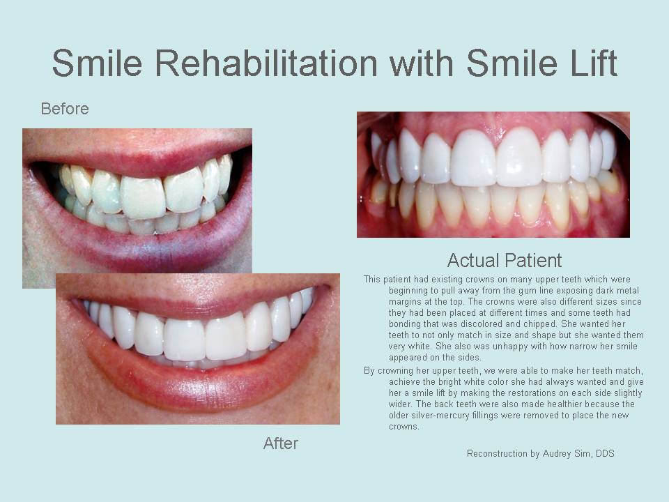 Smile rehabilitation with smile lift before and after